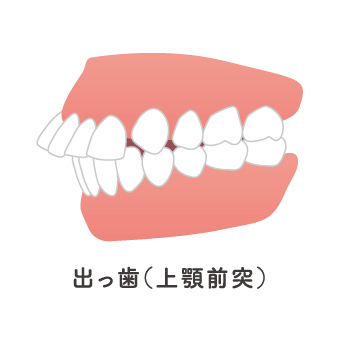 出っ歯（上顎前突）のイメージ