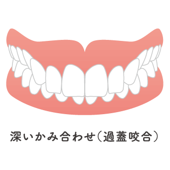 過蓋咬合のイメージ