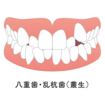乱杭歯・八重歯・叢生のイメージ