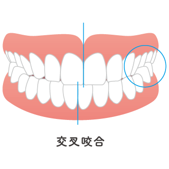 交叉咬合のイメージ